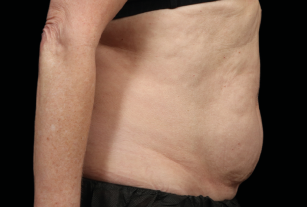 Abdomen After