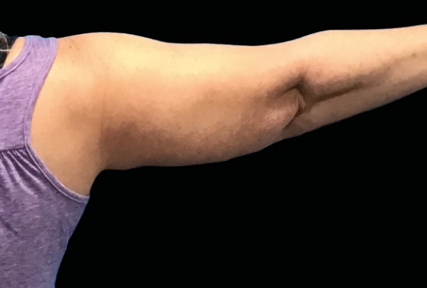 Arms definition After