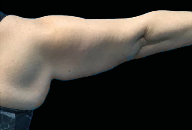 Arms definition Before