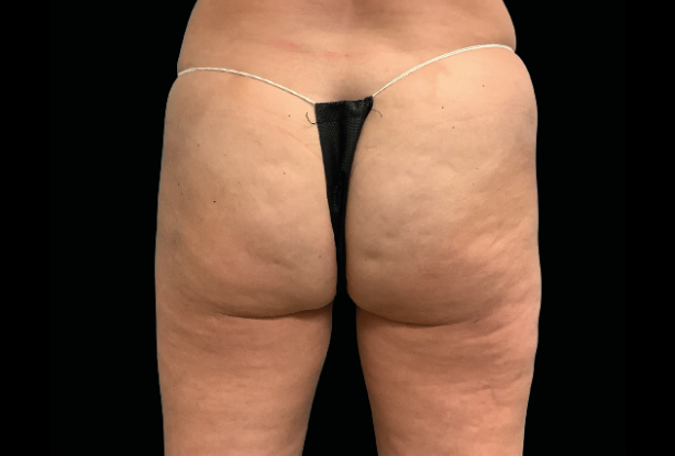 Buttocks lift After