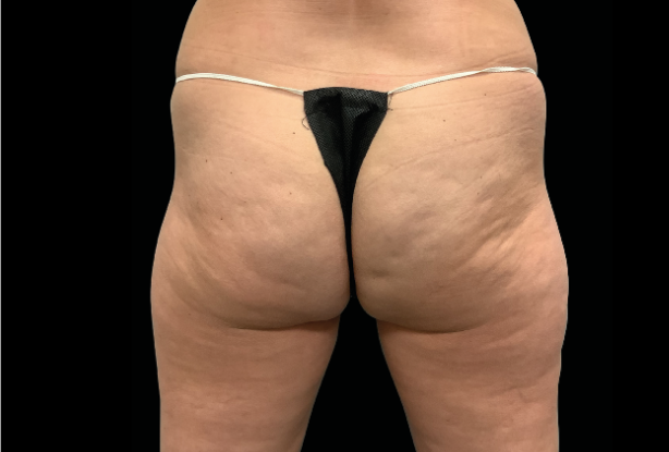Buttocks lift Before