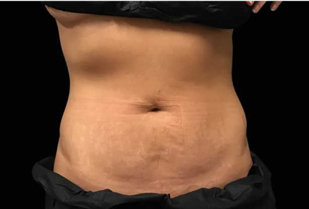 Abdomen Before