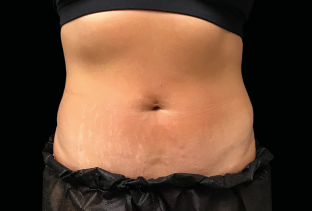 Abdomen After