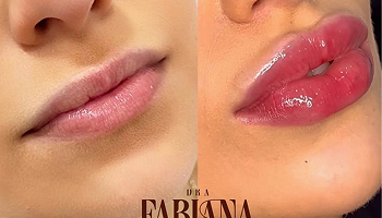 Antes e depois preenchimento labial