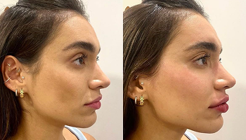 antes e depois harmonização facial