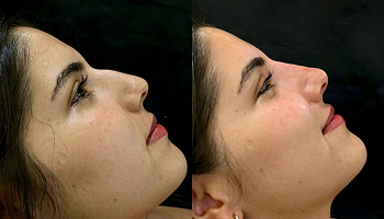 antes e depois rinomodelação