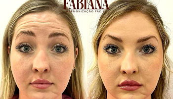 Antes e depois toxina botulína