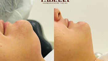 Antes e depois lipo de papada