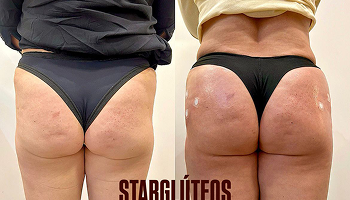 Antes e depois harmonização glútea