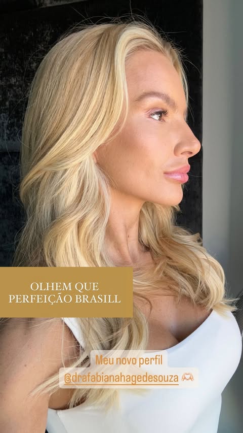 Resultado Harmonização Facial Starcliniq