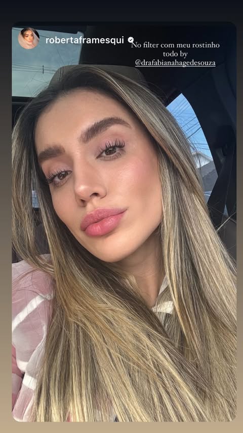 Resultado Harmonização Facial Starcliniq