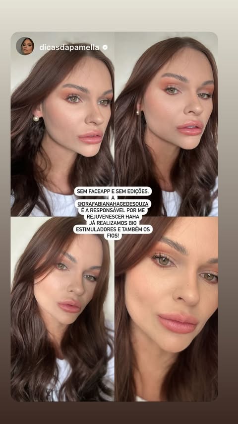 Resultado Harmonização Facial Starcliniq