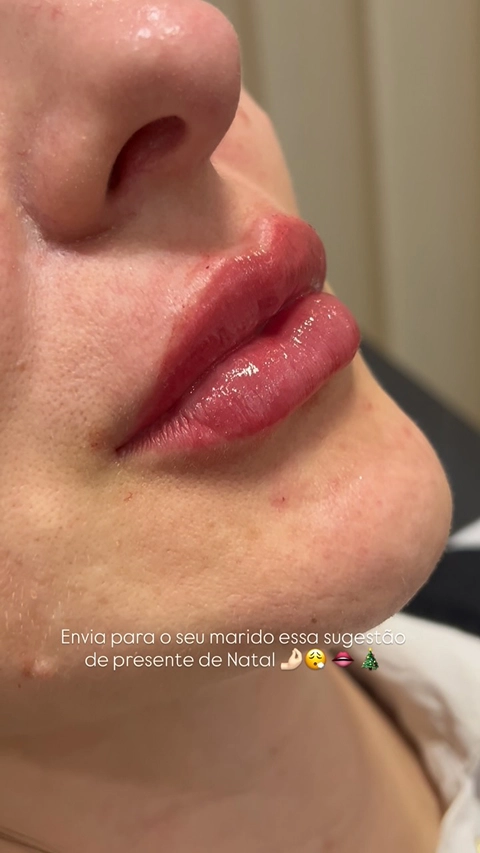 Resultado Harmonização Facial Starcliniq