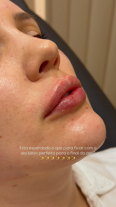 Resultado Harmonização Facial Starcliniq