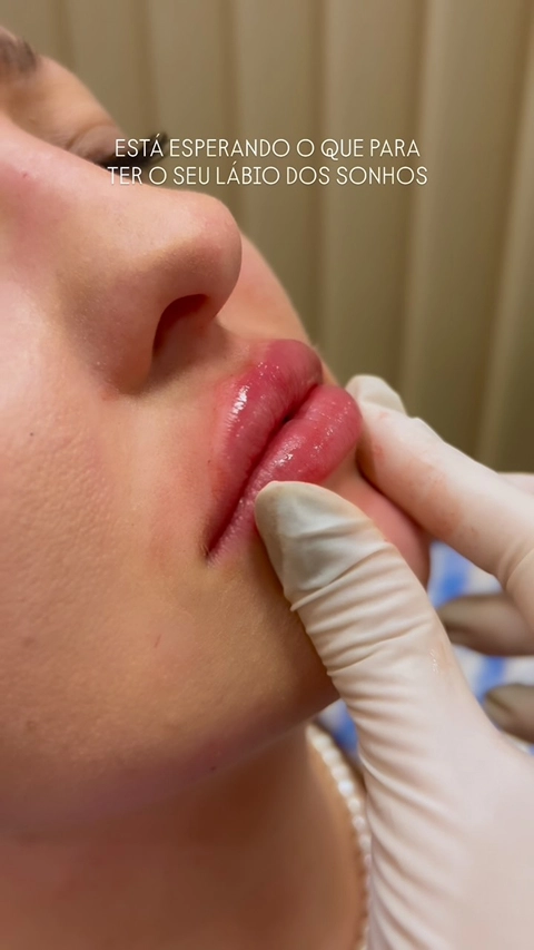 Resultado Harmonização Facial Starcliniq