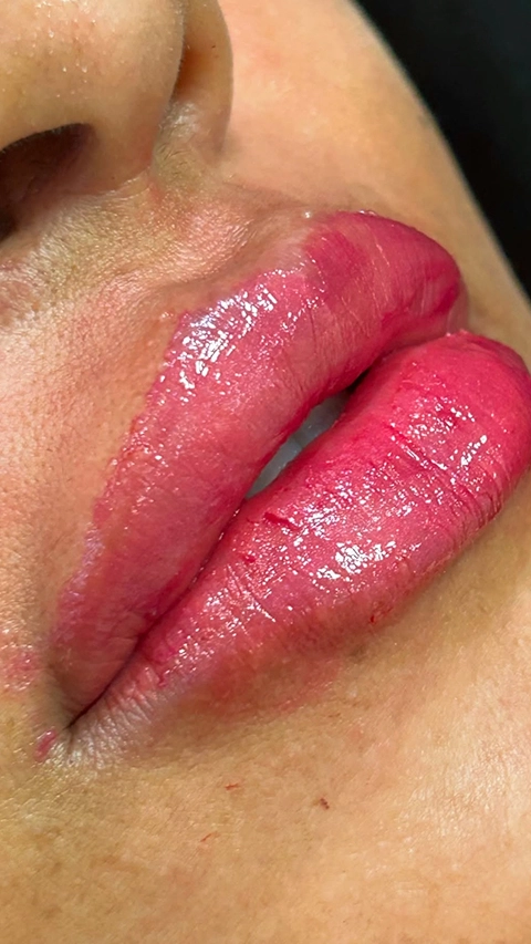 Resultado Harmonização Facial Starcliniq