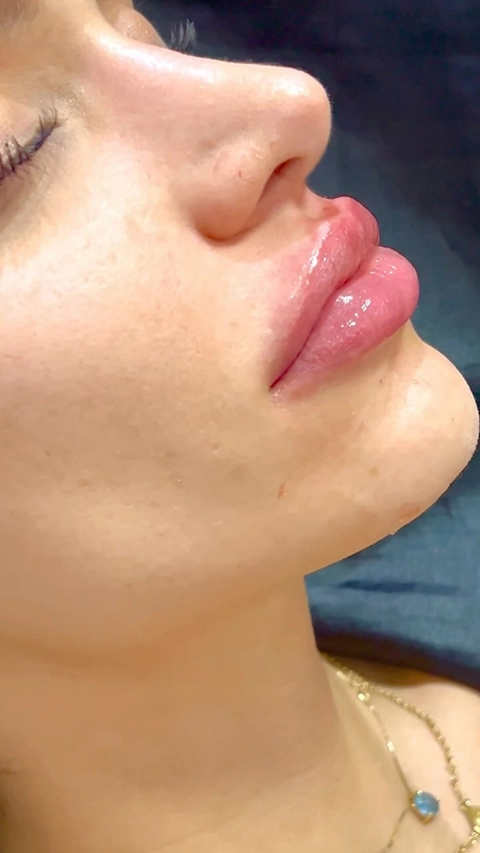 Resultado Harmonização Facial Starcliniq