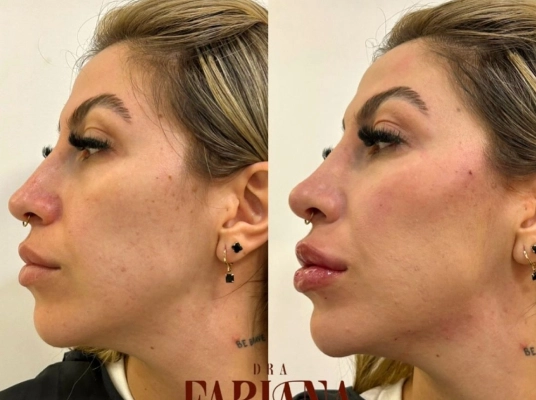 procedimento-preenchimento-labial-acido-hialuronico-araucaria-dra-fabiana-souza
