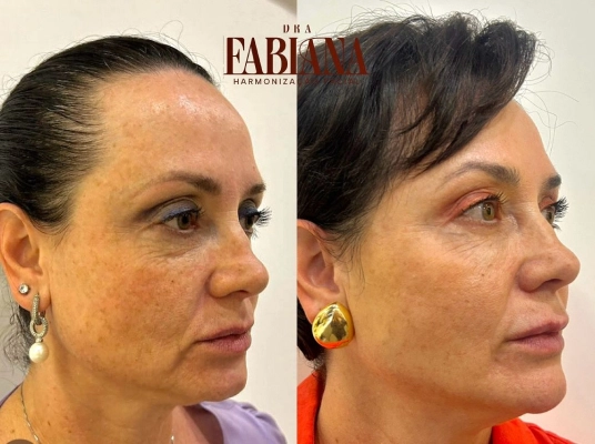 aplicacao-de-bioestimulador-sculptra-para-flacidez-facial-em-araucaria