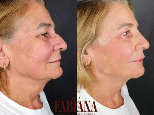 suavizacao-de-linhas-de-expressao-e-rugas-na-testa-clinica-araucaria