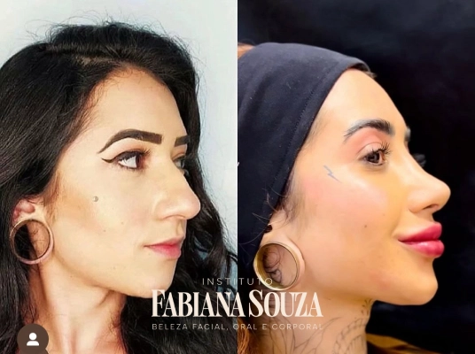 sessao-de-laser-lavieen-para-clareamento-de-manchas-e-poros-araucaria