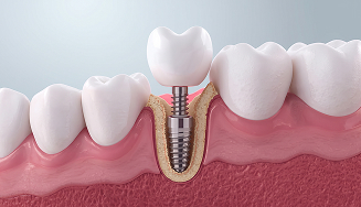 Implantes