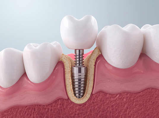 implante-unitario-dente-perdido-araucaria-dr-bruno