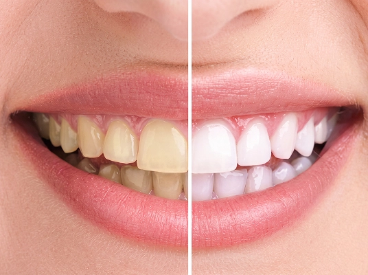 procedimento-preenchimento-labial-acido-hialuronico-araucaria-dra-fabiana-souza