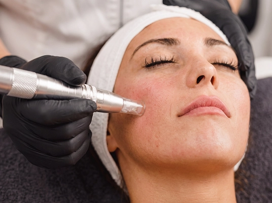 aplicacao-de-bioestimulador-sculptra-para-flacidez-facial-em-araucaria