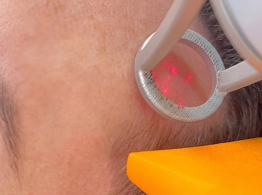 procedimento-preenchimento-labial-acido-hialuronico-araucaria-dra-fabiana-souza