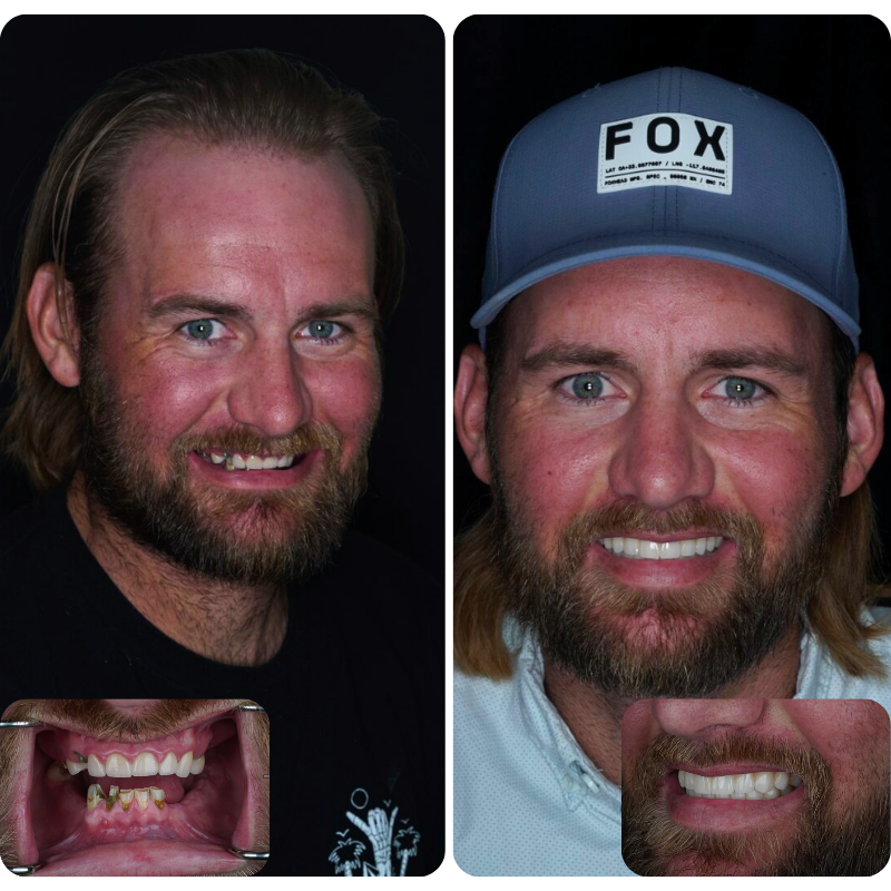 Before and after dental implant patient
