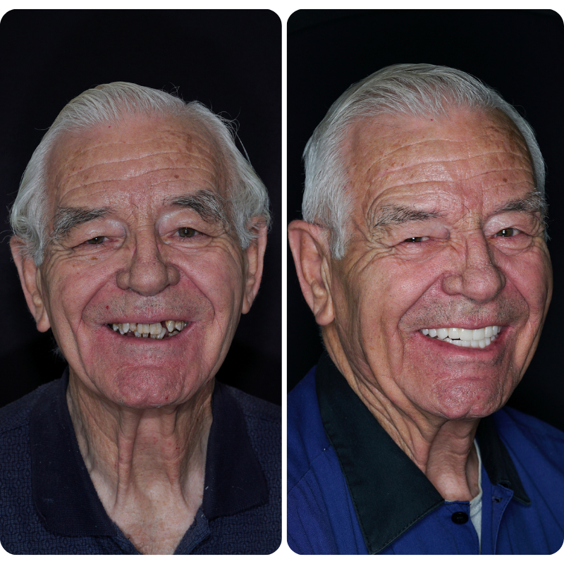 Before and after dental implant patient