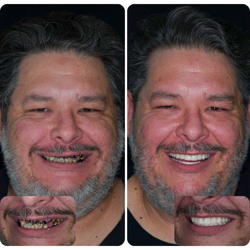 Before and after dental implant patient