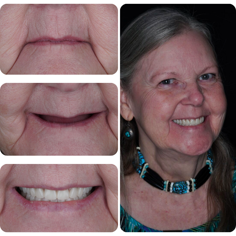 Before and after dental implant patient