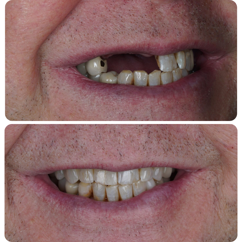 Before and after dental implant patient
