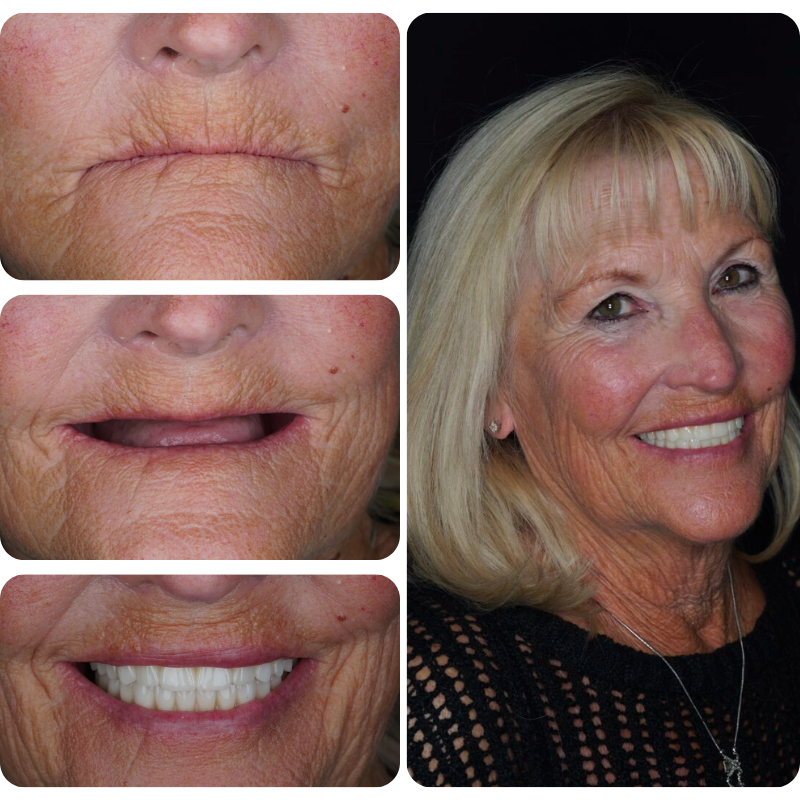 Before and after dental implant patient