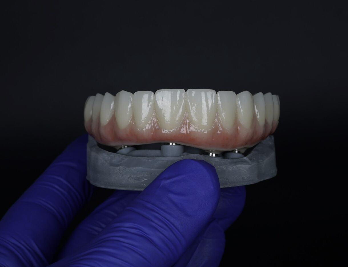 All-on-4 dental implant illustration