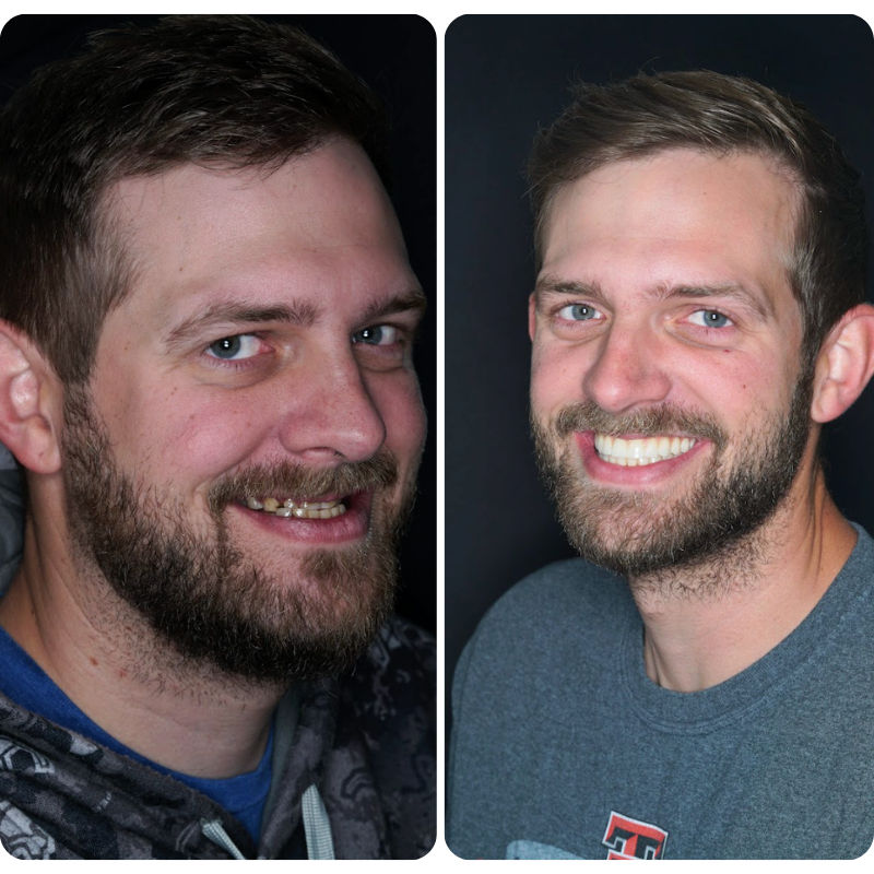 Before and after dental implant patient