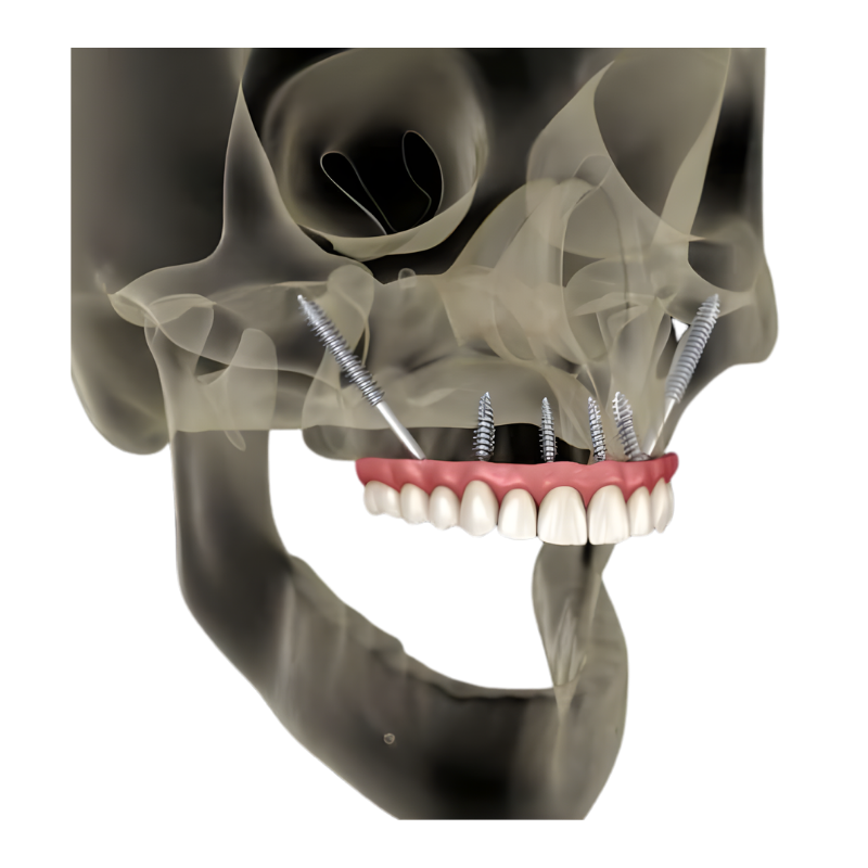 all on x dental implants