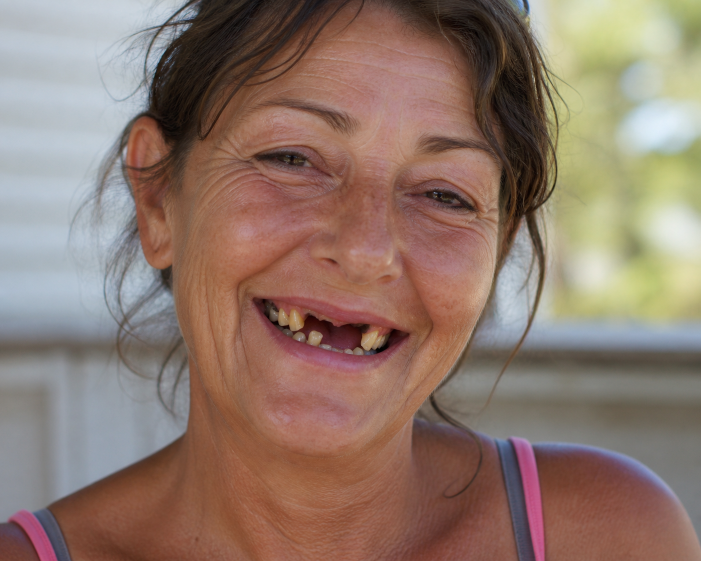 Before treatment patient smile