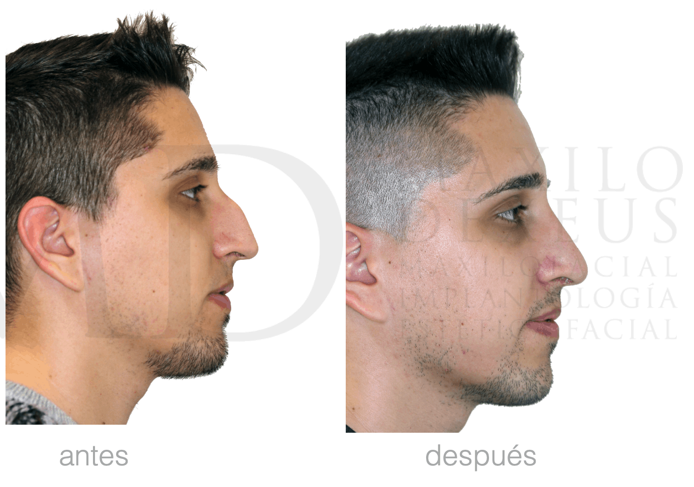 Antes y después — Rinofast