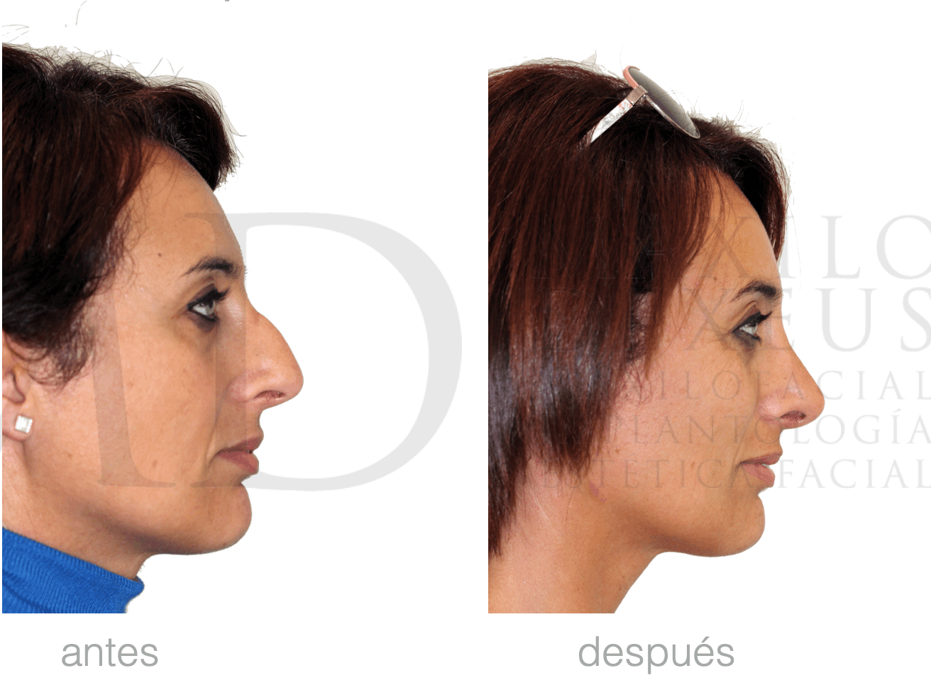 Antes y después — Rinofast