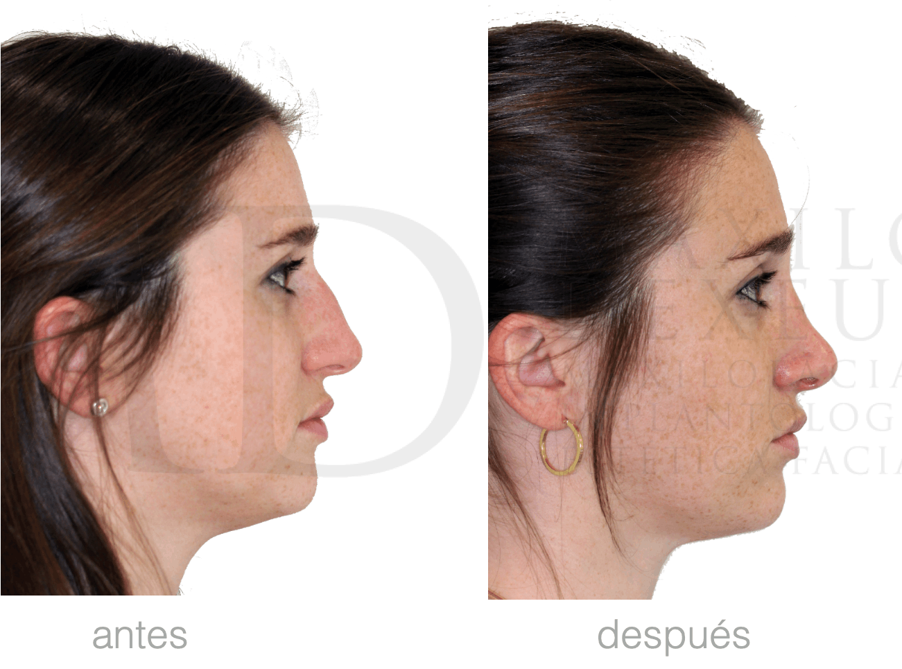 Antes y después — Rinofast