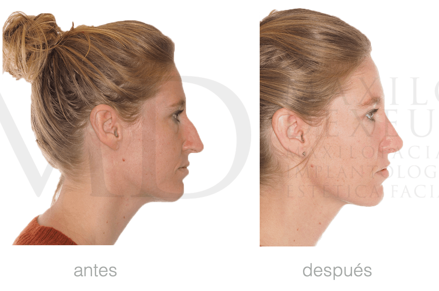 Antes y después — Rinofast
