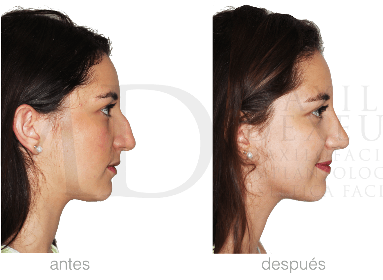Antes y después — Rinofast