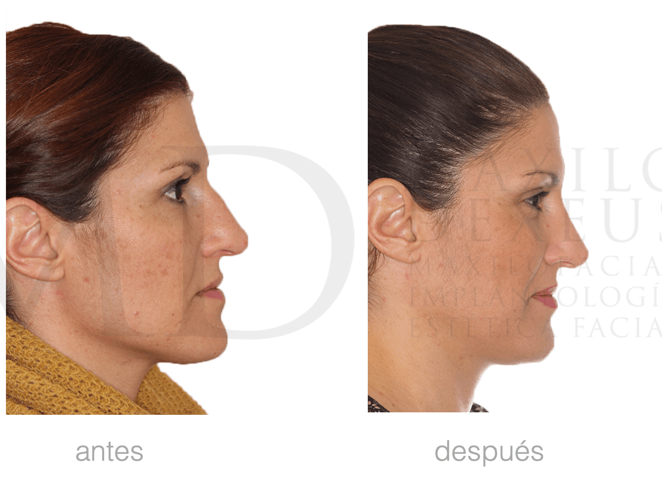 Antes y después — Rinofast