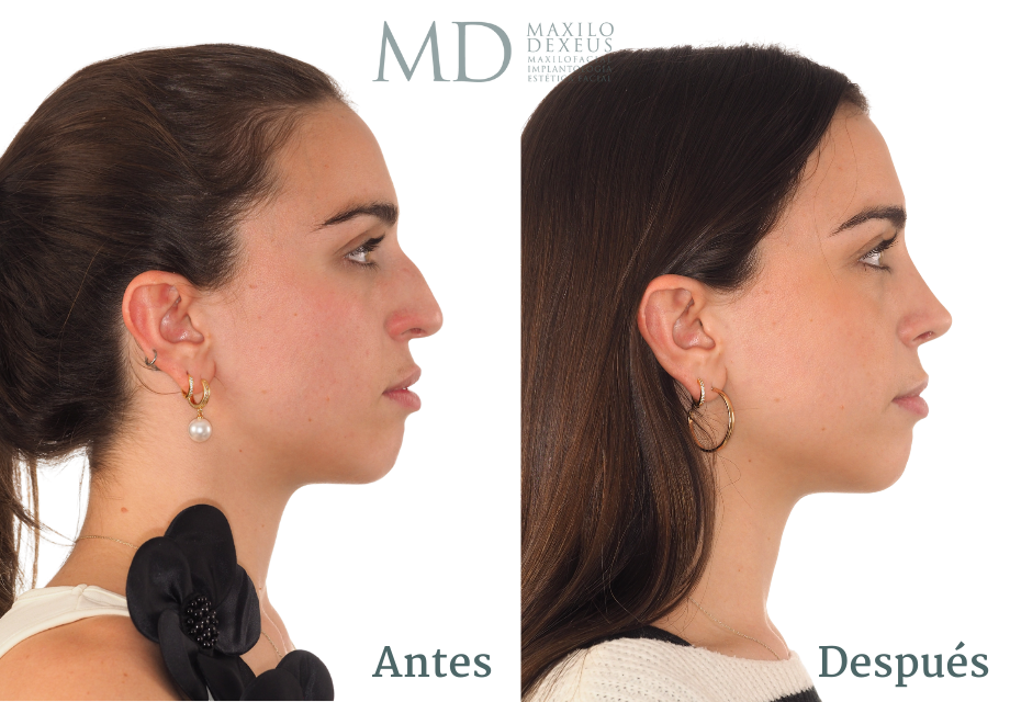 Antes y después — Rinofast