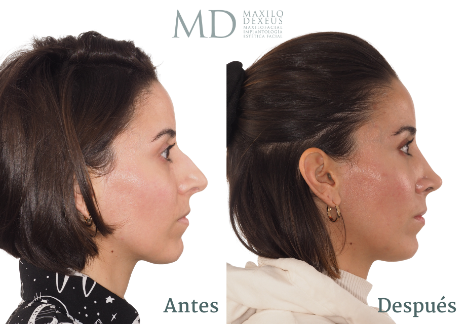 Antes y después — Rinofast