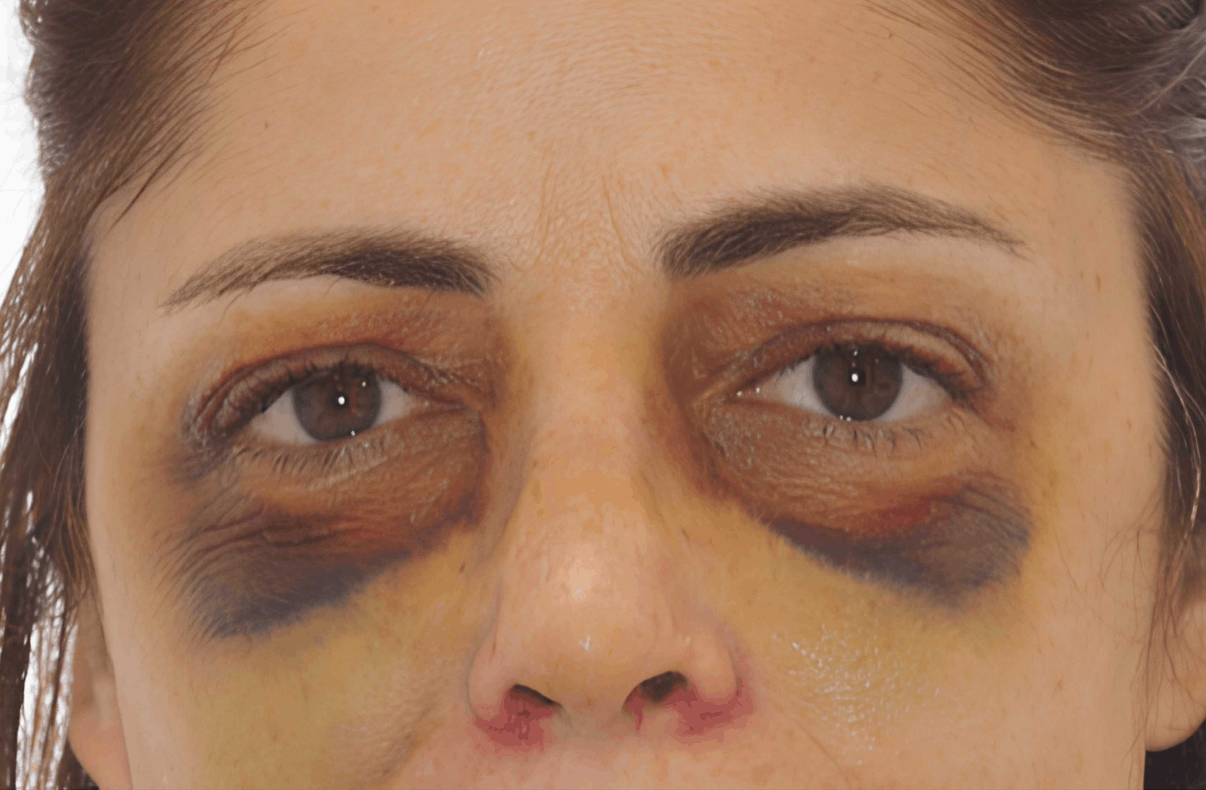 Postoperatorio rinoplastia tradicional, 5 días