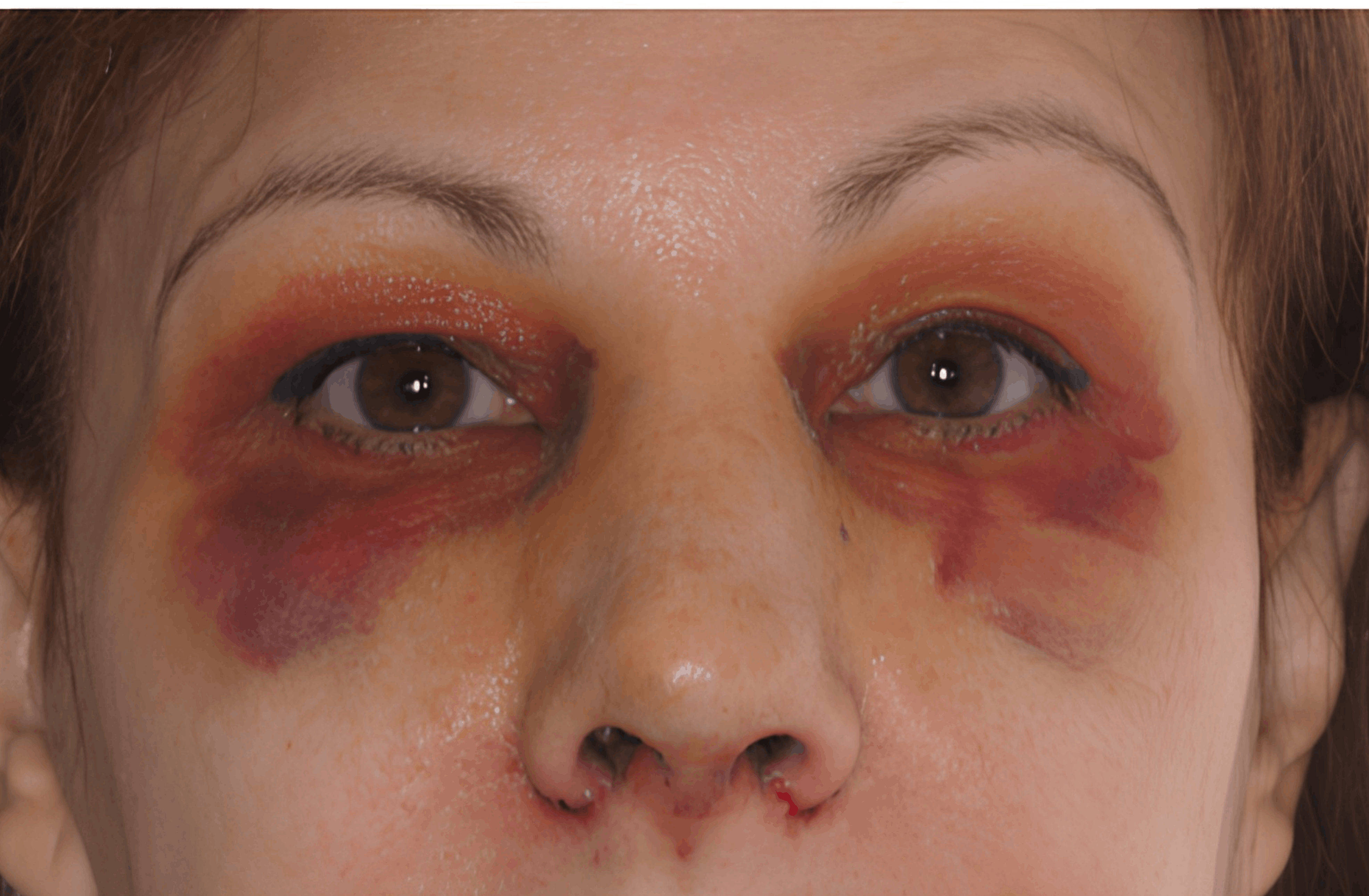 Postoperatorio rinoplastia tradicional, 5 días